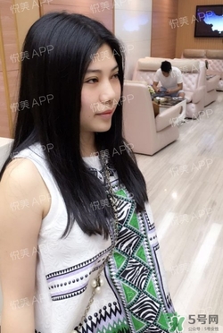 切開雙眼皮消腫過(guò)程圖_切開雙眼皮恢復(fù)過(guò)程圖