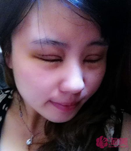 三點雙眼皮恢復(fù)過程圖_韓式三點雙眼皮多久恢復(fù)自然 三點雙眼皮恢復(fù)過程圖_韓式三點雙眼皮多久恢復(fù)自然