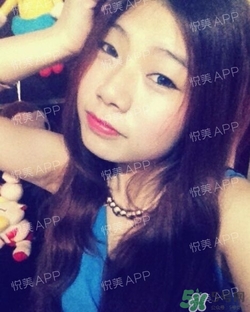 切開雙眼皮消腫過(guò)程圖_切開雙眼皮恢復(fù)過(guò)程圖