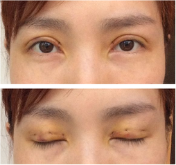 三點雙眼皮恢復(fù)過程圖_韓式三點雙眼皮多久恢復(fù)自然 三點雙眼皮恢復(fù)過程圖_韓式三點雙眼皮多久恢復(fù)自然