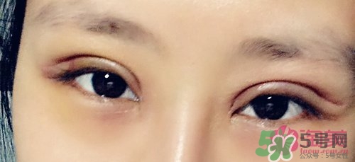 切開(kāi)雙眼皮多久消腫？切開(kāi)雙眼皮多久恢復(fù)？