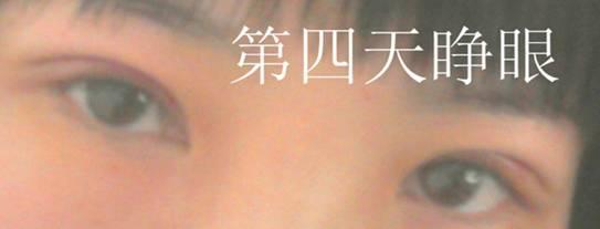 三點雙眼皮恢復(fù)過程圖_韓式三點雙眼皮多久恢復(fù)自然 三點雙眼皮恢復(fù)過程圖_韓式三點雙眼皮多久恢復(fù)自然