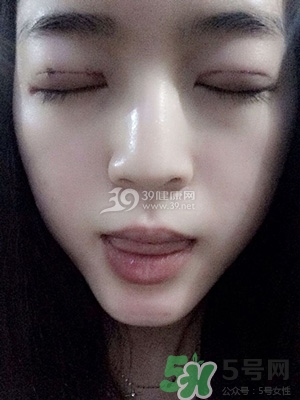 什么是定點(diǎn)雙眼皮？定點(diǎn)雙眼皮多少錢？