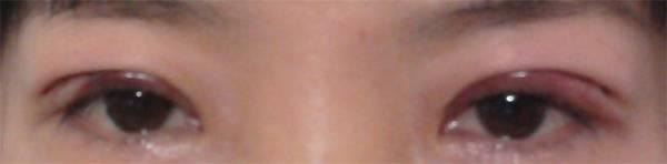 三點雙眼皮恢復(fù)過程圖_韓式三點雙眼皮多久恢復(fù)自然 三點雙眼皮恢復(fù)過程圖_韓式三點雙眼皮多久恢復(fù)自然