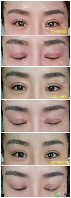 埋線雙眼皮能保持多久？埋線雙眼皮是永久嗎