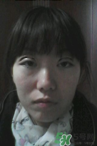 什么是定點(diǎn)雙眼皮？定點(diǎn)雙眼皮多少錢？