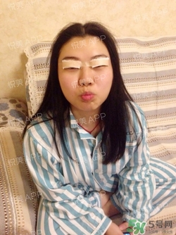 切開雙眼皮消腫過(guò)程圖_切開雙眼皮恢復(fù)過(guò)程圖