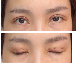 三點雙眼皮恢復(fù)過程圖_韓式三點雙眼皮多久恢復(fù)自然 三點雙眼皮恢復(fù)過程圖_韓式三點雙眼皮多久恢復(fù)自然