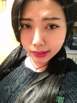 切開雙眼皮消腫過(guò)程圖_切開雙眼皮恢復(fù)過(guò)程圖