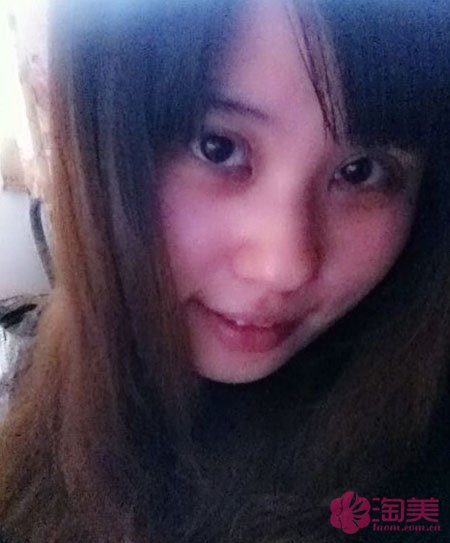 三點雙眼皮恢復(fù)過程圖_韓式三點雙眼皮多久恢復(fù)自然 三點雙眼皮恢復(fù)過程圖_韓式三點雙眼皮多久恢復(fù)自然