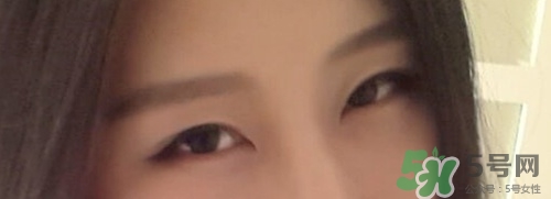 切開(kāi)雙眼皮多久消腫？切開(kāi)雙眼皮多久恢復(fù)？