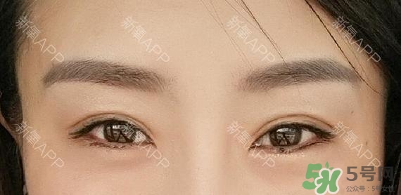 埋線雙眼皮能保持多久？埋線雙眼皮是永久嗎