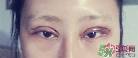 切開(kāi)雙眼皮多久消腫？切開(kāi)雙眼皮多久恢復(fù)？