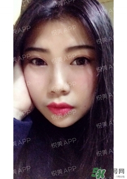 切開雙眼皮消腫過(guò)程圖_切開雙眼皮恢復(fù)過(guò)程圖