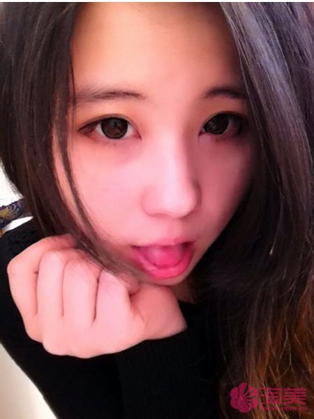 三點雙眼皮恢復(fù)過程圖_韓式三點雙眼皮多久恢復(fù)自然 三點雙眼皮恢復(fù)過程圖_韓式三點雙眼皮多久恢復(fù)自然