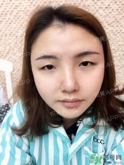 定點雙眼皮恢復(fù)過程圖_定點雙眼皮要多久恢復(fù) 定點雙眼皮恢復(fù)過程圖_定點雙眼皮要多久恢復(fù)