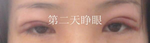 三點雙眼皮恢復(fù)過程圖_韓式三點雙眼皮多久恢復(fù)自然 三點雙眼皮恢復(fù)過程圖_韓式三點雙眼皮多久恢復(fù)自然