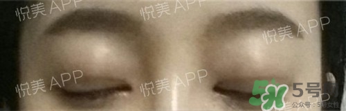 埋線雙眼皮多久恢復(fù)自然？埋線雙眼皮多久能恢復(fù)