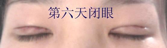 三點雙眼皮恢復(fù)過程圖_韓式三點雙眼皮多久恢復(fù)自然 三點雙眼皮恢復(fù)過程圖_韓式三點雙眼皮多久恢復(fù)自然