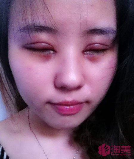 三點雙眼皮恢復(fù)過程圖_韓式三點雙眼皮多久恢復(fù)自然 三點雙眼皮恢復(fù)過程圖_韓式三點雙眼皮多久恢復(fù)自然