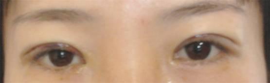 三點雙眼皮恢復(fù)過程圖_韓式三點雙眼皮多久恢復(fù)自然 三點雙眼皮恢復(fù)過程圖_韓式三點雙眼皮多久恢復(fù)自然