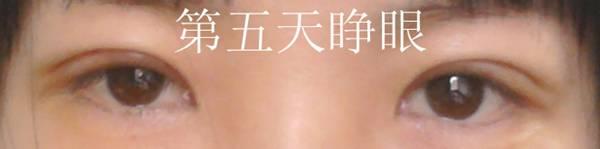 三點雙眼皮恢復(fù)過程圖_韓式三點雙眼皮多久恢復(fù)自然 三點雙眼皮恢復(fù)過程圖_韓式三點雙眼皮多久恢復(fù)自然
