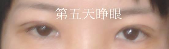 三點雙眼皮恢復(fù)過程圖_韓式三點雙眼皮多久恢復(fù)自然 三點雙眼皮恢復(fù)過程圖_韓式三點雙眼皮多久恢復(fù)自然