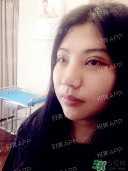 切開雙眼皮消腫過(guò)程圖_切開雙眼皮恢復(fù)過(guò)程圖