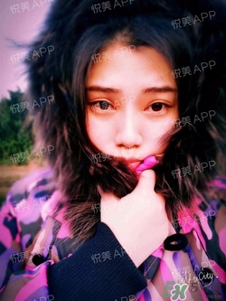 切開雙眼皮消腫過(guò)程圖_切開雙眼皮恢復(fù)過(guò)程圖