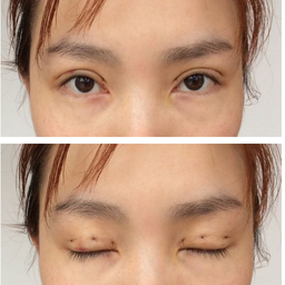 三點雙眼皮恢復(fù)過程圖_韓式三點雙眼皮多久恢復(fù)自然 三點雙眼皮恢復(fù)過程圖_韓式三點雙眼皮多久恢復(fù)自然