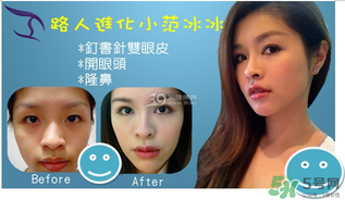 重瞼術是什么？重瞼術是永久的嗎？