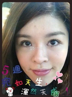 重瞼術是什么？重瞼術是永久的嗎？