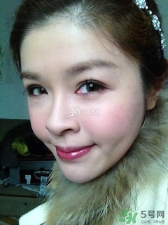 重瞼術是什么？重瞼術是永久的嗎？
