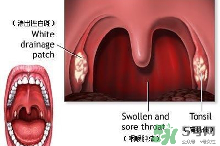 霧霾天喉嚨痛怎么辦？霧霾天嗓子疼怎么辦？