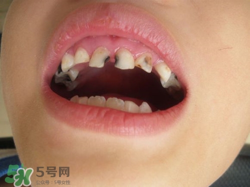 小孩換牙半年還沒長出來是怎么回事?小孩換牙注意事項(xiàng)