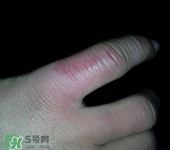 小拇指凍腫了怎么辦？為什么小拇指容易凍？