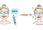 咬肌會(huì)改變臉型嗎？切除咬肌會(huì)改變臉型嗎？