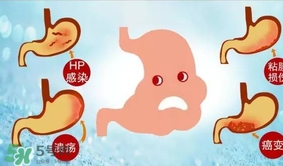 神經(jīng)性胃痙攣是什么？神經(jīng)性胃痙攣是什么原因？