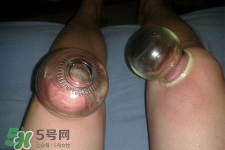 小腿能拔罐嗎？在小腿上拔火罐有什么作用？