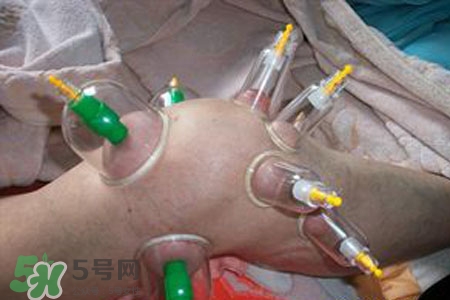 小腿能拔罐嗎？在小腿上拔火罐有什么作用？