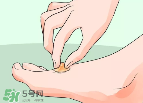 水泡怎么處理？水泡要不要刺破？