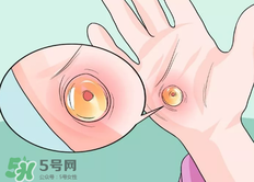 水泡怎么處理？水泡要不要刺破？