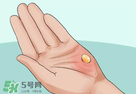 水泡怎么處理？水泡要不要刺破？