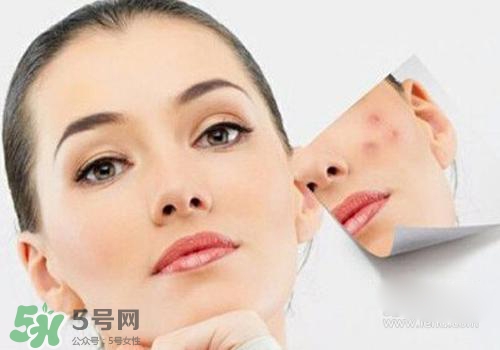 封閉性粉刺會自己消失嗎？封閉性粉刺好了會留疤嗎？