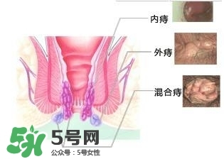 痔瘡吃什么藥效果好？痔瘡吃什么藥好得快？