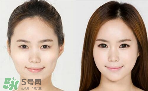 瘦臉針分為幾種類型？瘦臉針有哪幾個牌子？