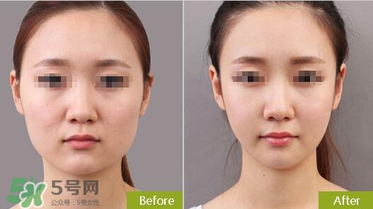 瘦臉針分為幾種類型？瘦臉針有哪幾個牌子？