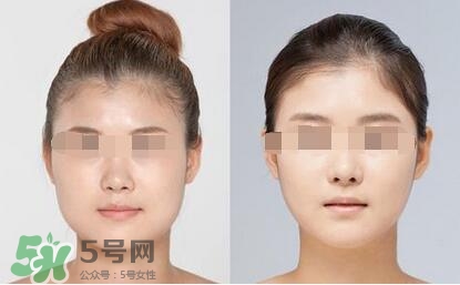 瘦臉針分為幾種類型？瘦臉針有哪幾個牌子？