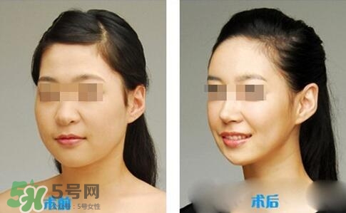 瘦臉針分為幾種類型？瘦臉針有哪幾個牌子？