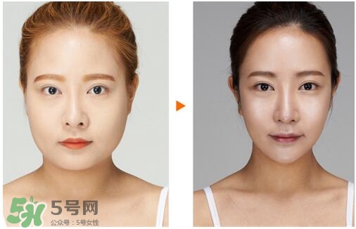 瘦臉針分為幾種類型？瘦臉針有哪幾個牌子？